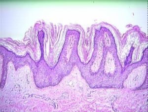 akantoz-acanthosis-nigricans